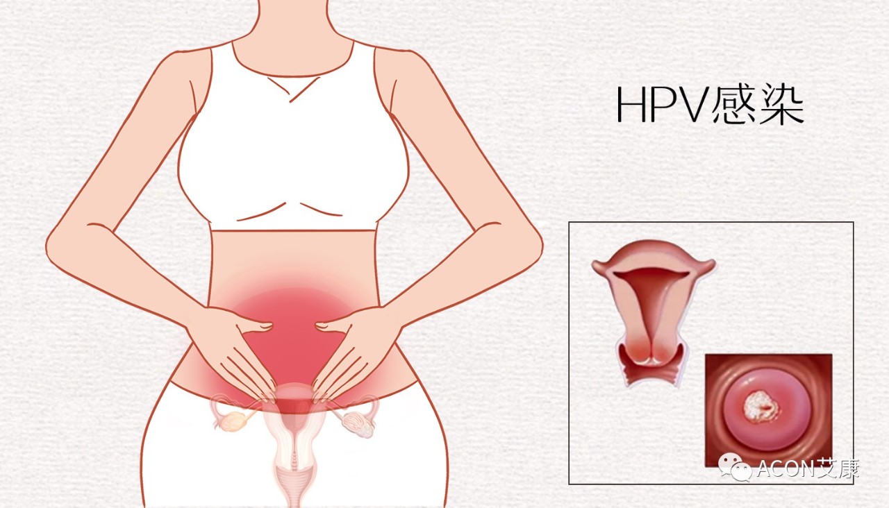 HPV轉(zhuǎn)陰其實(shí)很簡(jiǎn)單， 女性必知的宮頸癌真相