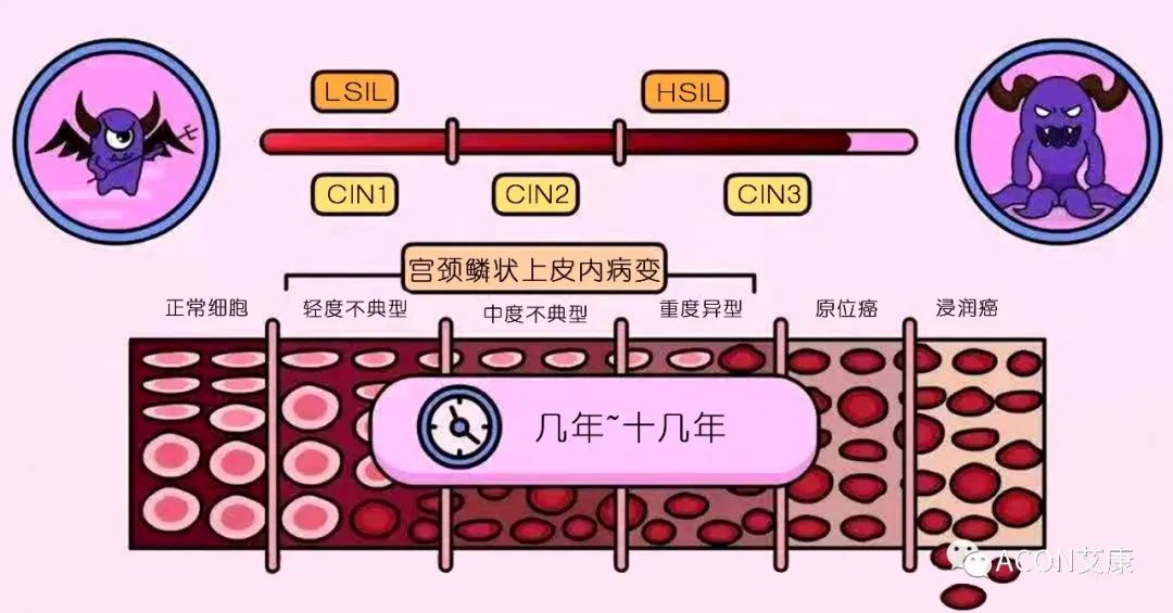 HPV轉(zhuǎn)陰其實(shí)很簡(jiǎn)單， 女性必知的宮頸癌真相